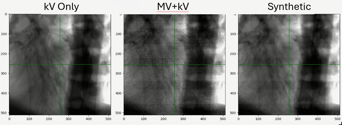 Neural Scatter Removal for Image-Guided Radiation Therapy
